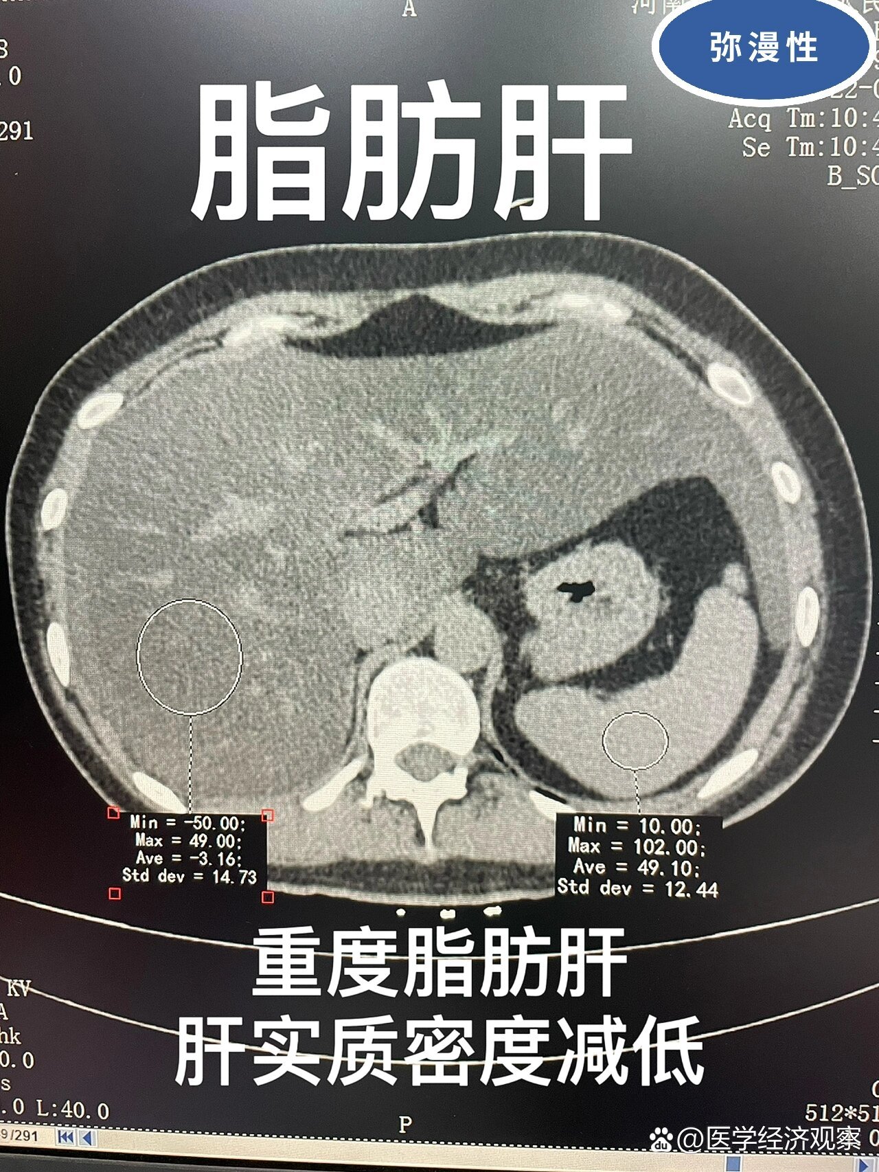 脂肪肝ct表现图片图片