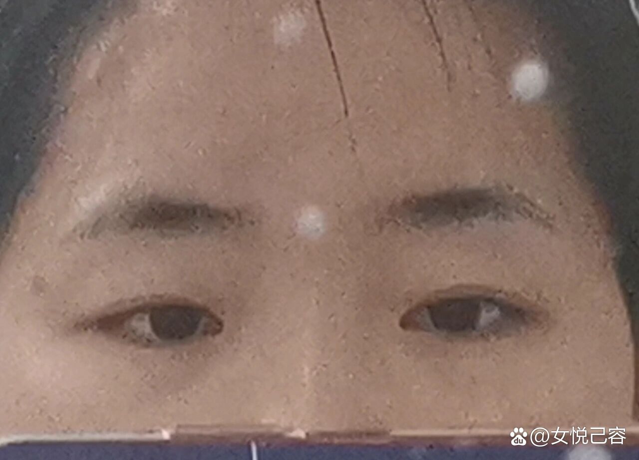 的评论,有人会问我这个问题,既然能帮到大家,就说说吧,我是先天性斜视