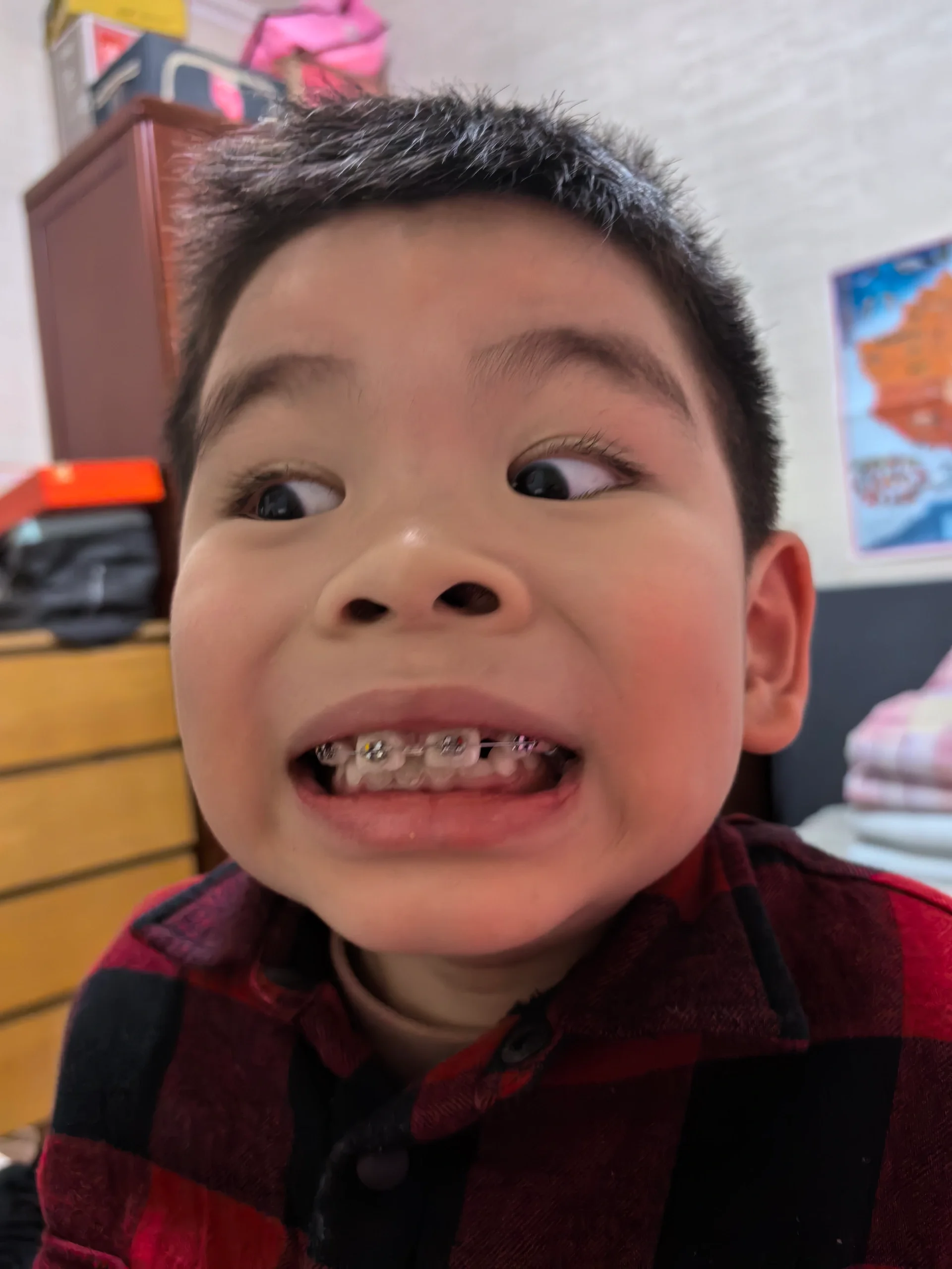 6岁大牙缝 倒置多生牙拯救记,整牙第一天