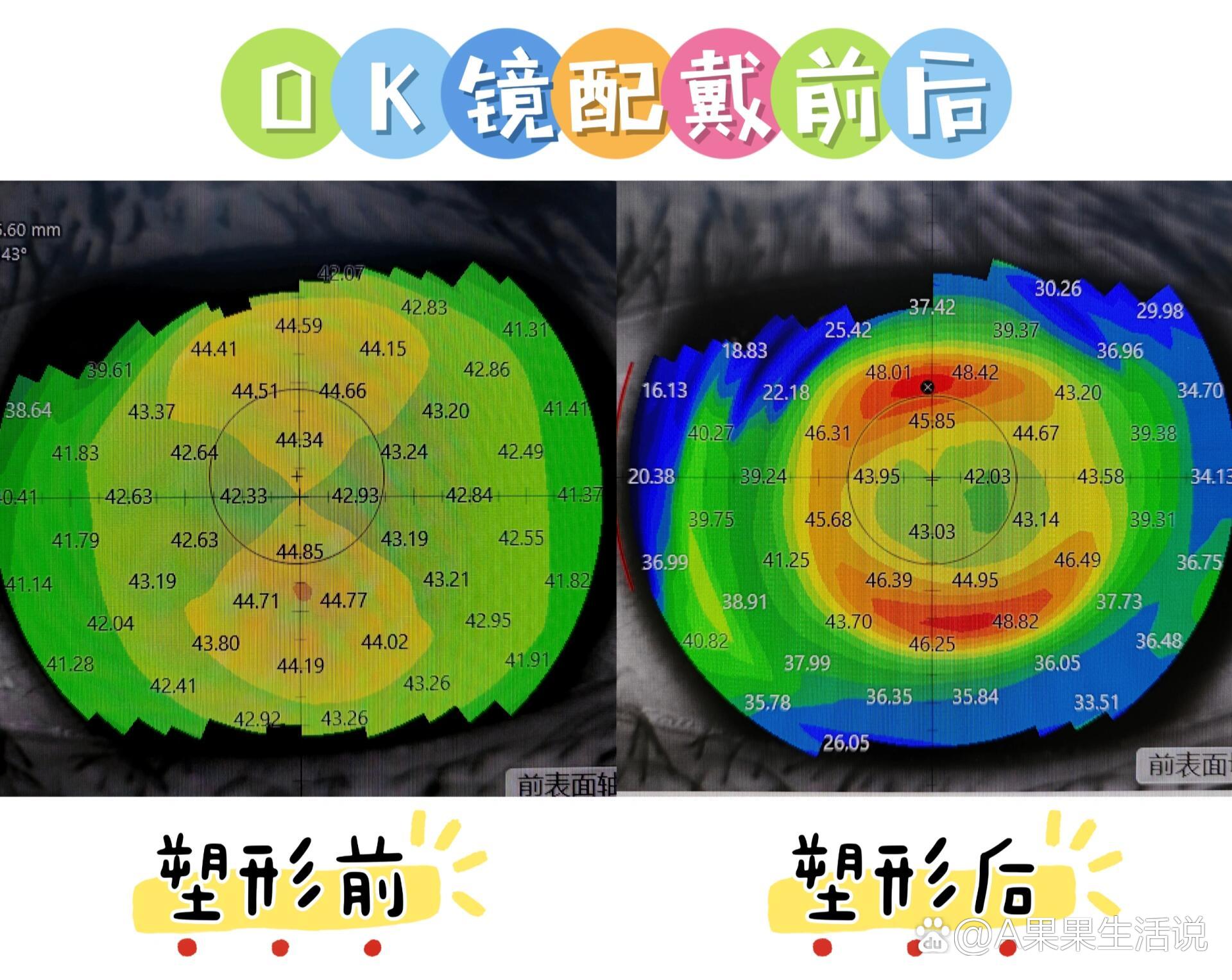 角膜地形图上看kappa角图片