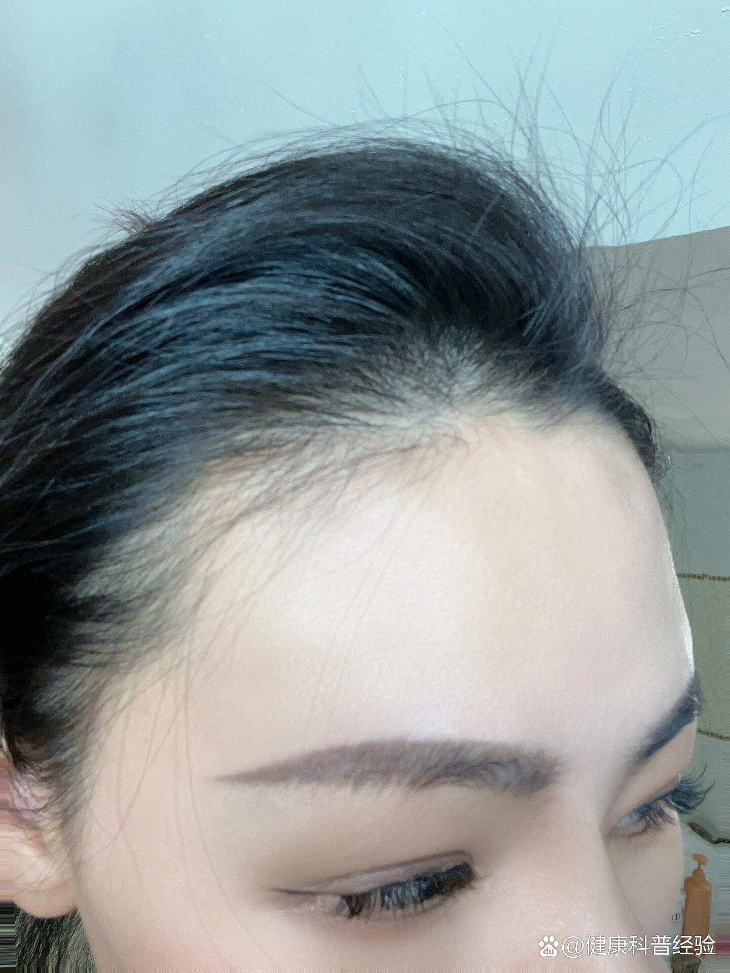 到今天生物素吃了正好三个月!前额的头发还可以长出来一些小绒毛!