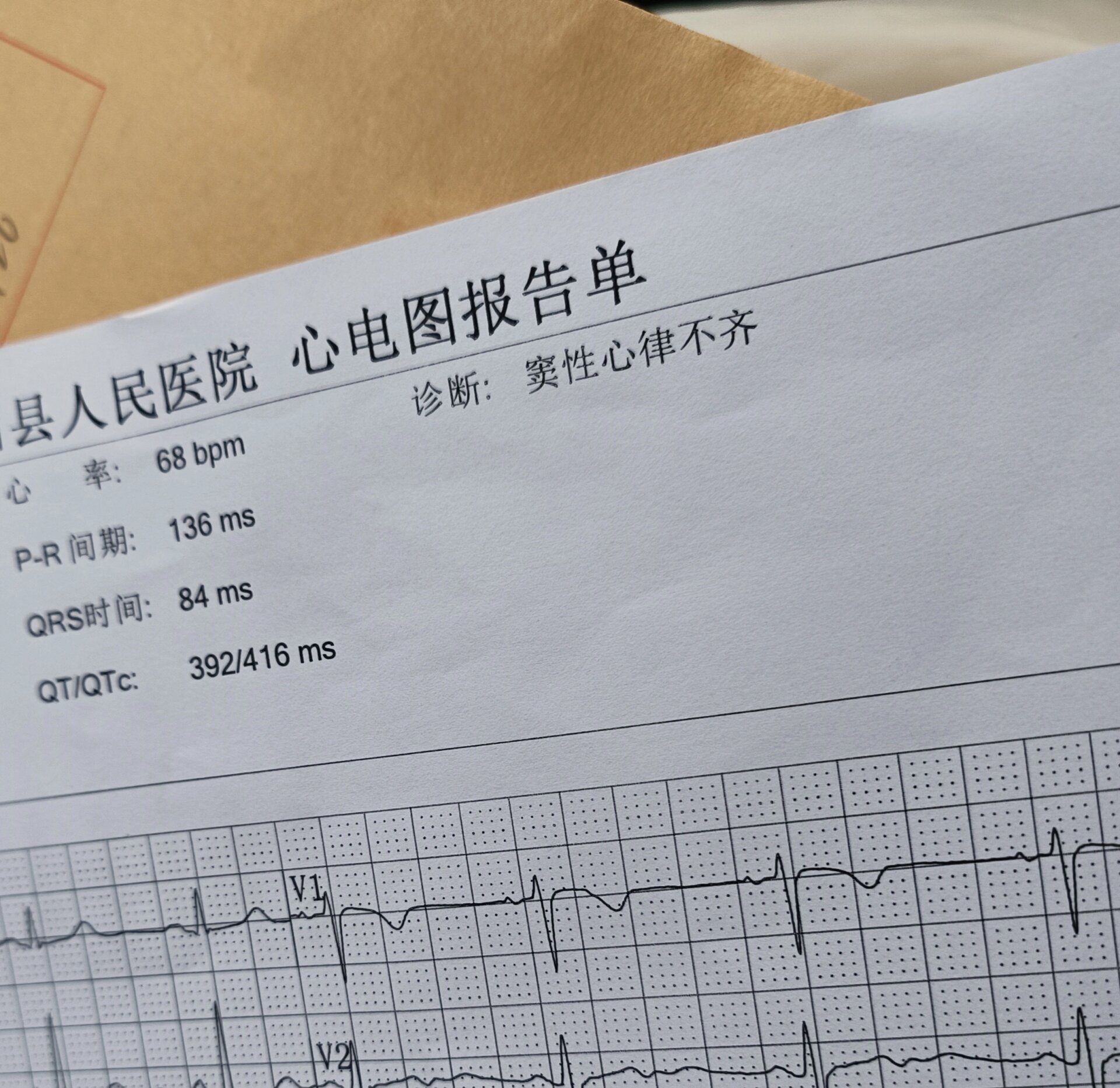 请问医生朋友心律不齐考编体检能过吗