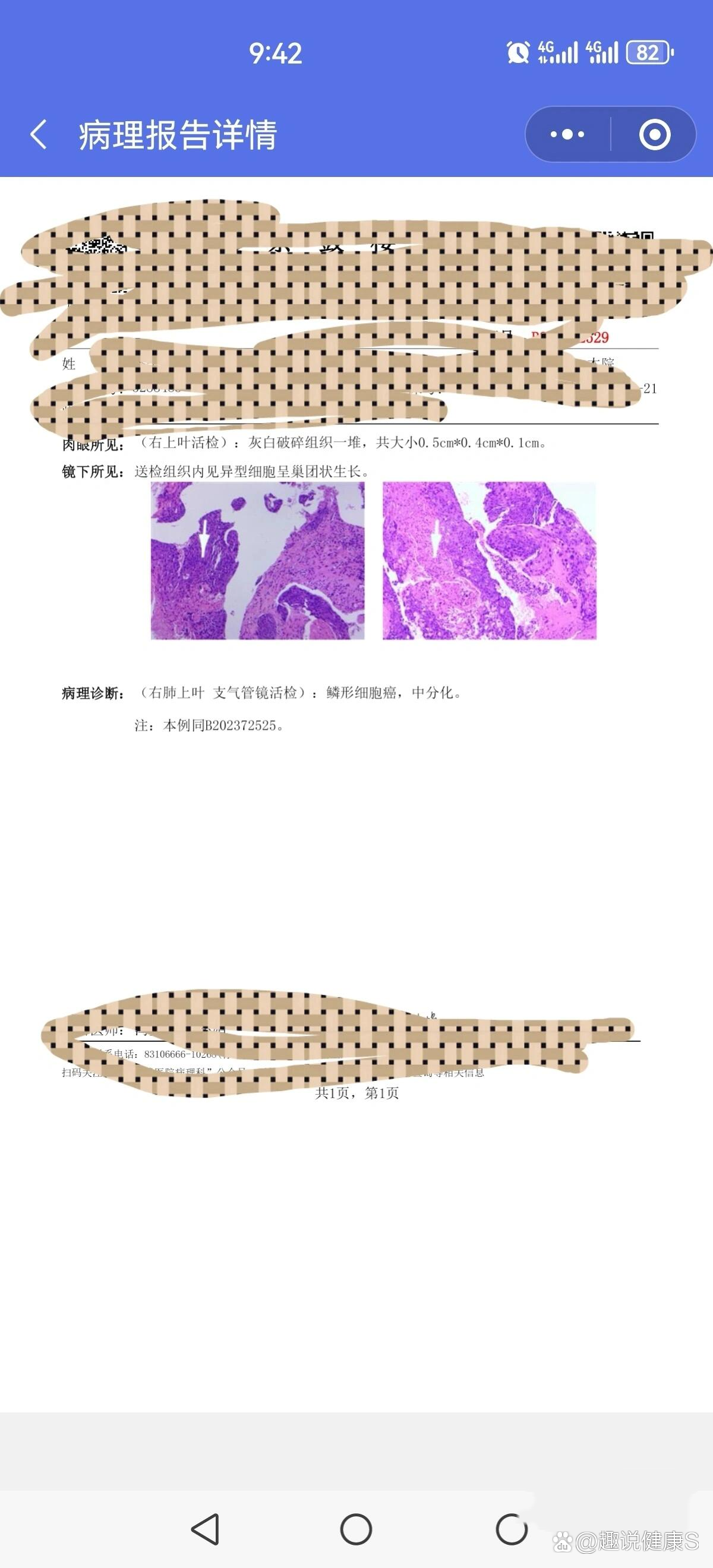  p>老爸的抗癌记录 br>11月26日第一次化疗,白蛋白紫杉醇 奈达铂,白