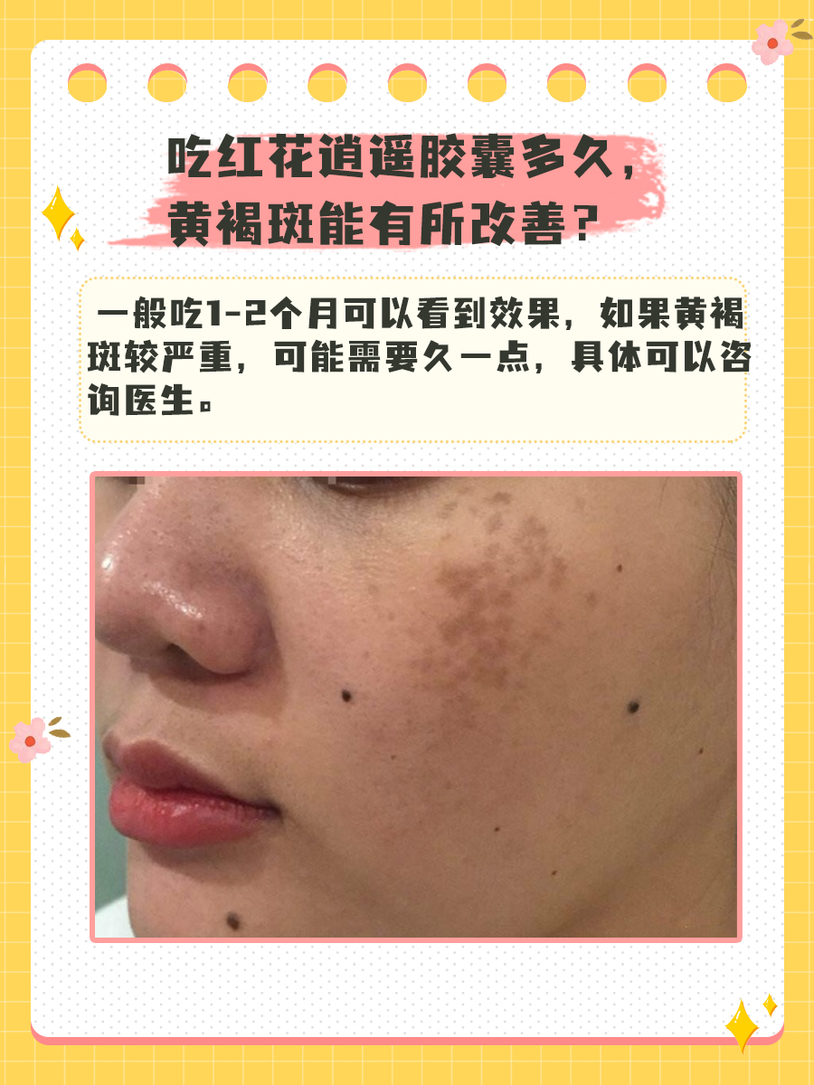 吃红花逍遥胶囊多久,黄褐斑能有所改善?