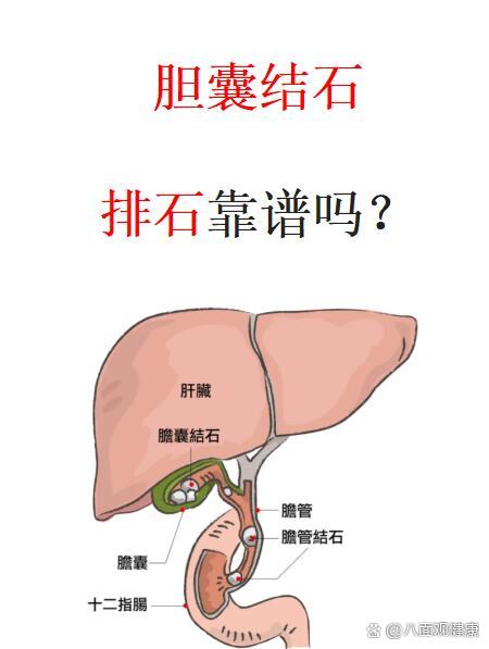 胆囊结石排石靠谱吗?