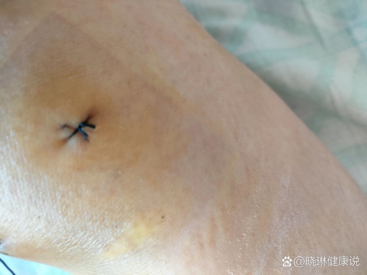 接受了必须要手术这个情况,医生说把盘状修成正常半月板形状,把撕裂的