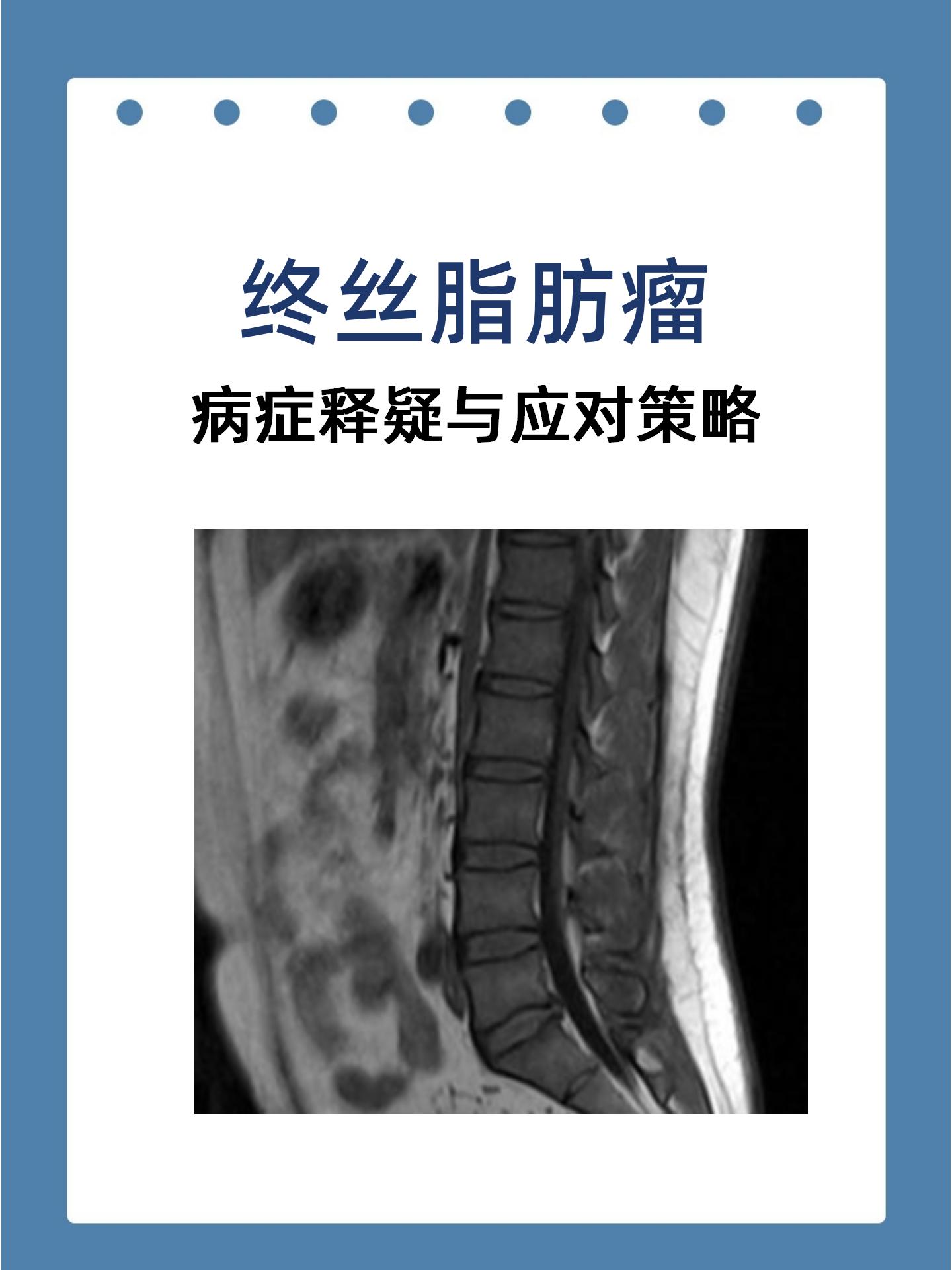 终丝脂肪瘤:病症释疑与应对策略