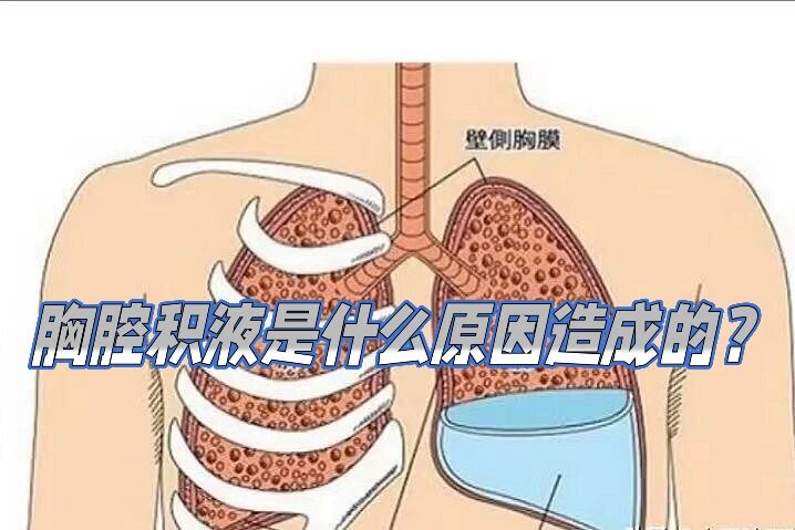 胸腔积液是什么原因造成的?