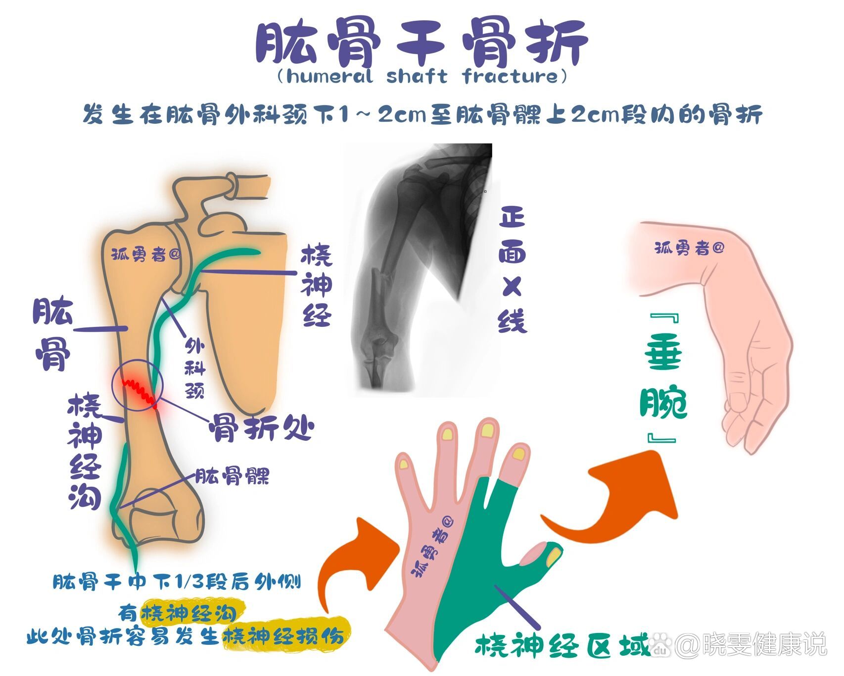 肱骨干骨折