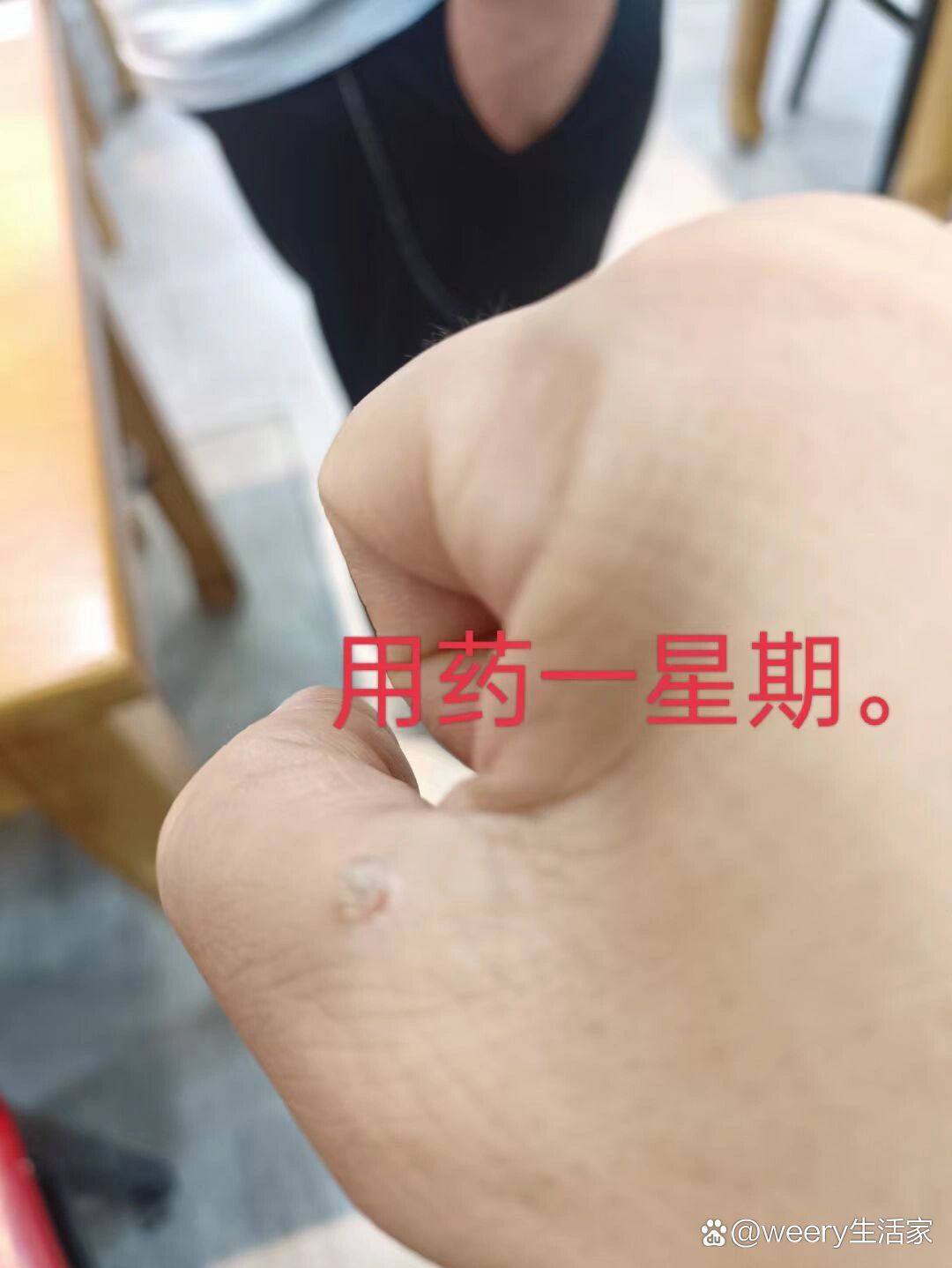 克疣液