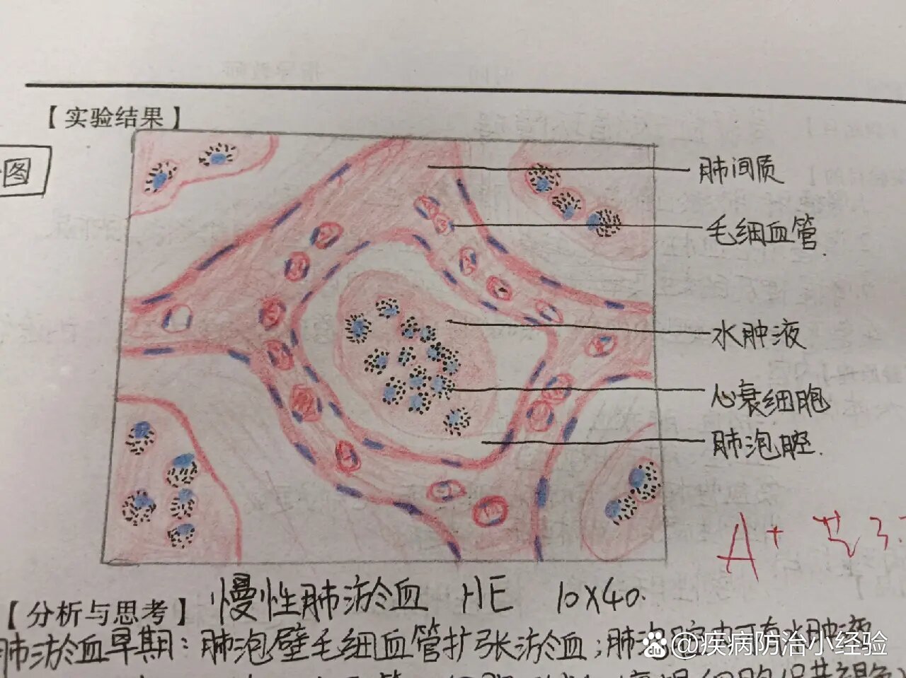 慢性肺淤血镜下实验图图片