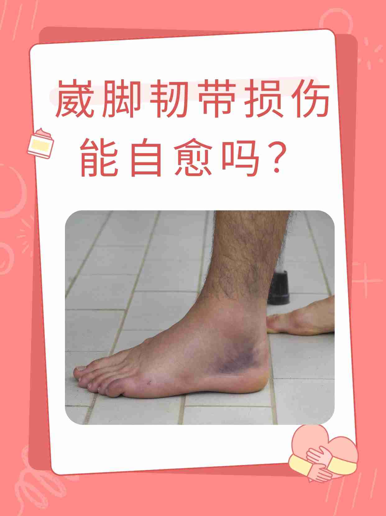 崴脚韧带损伤能自愈吗?