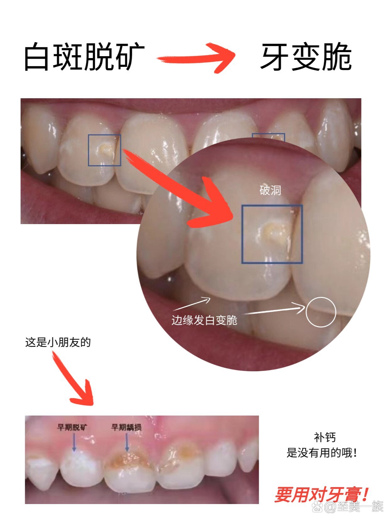 门牙上有白斑图片图片