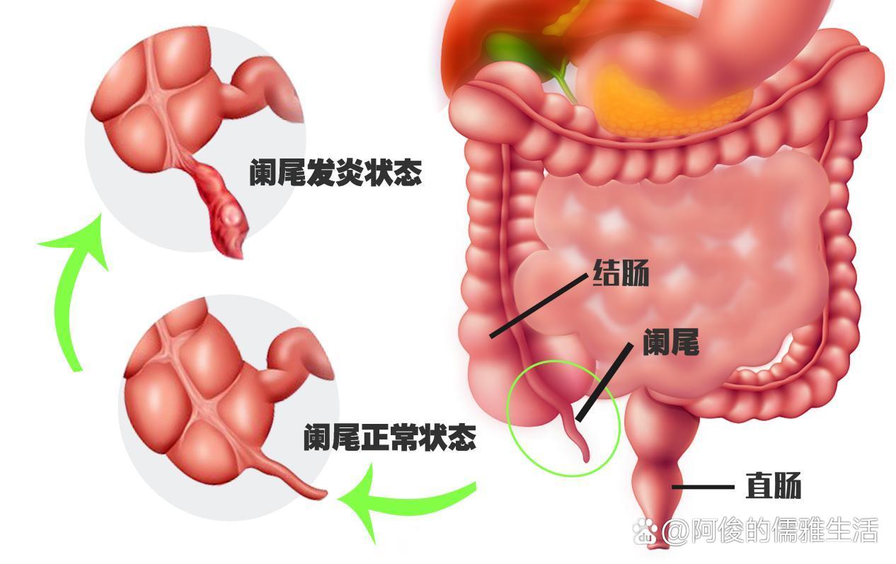 正常阑尾图片真实图片