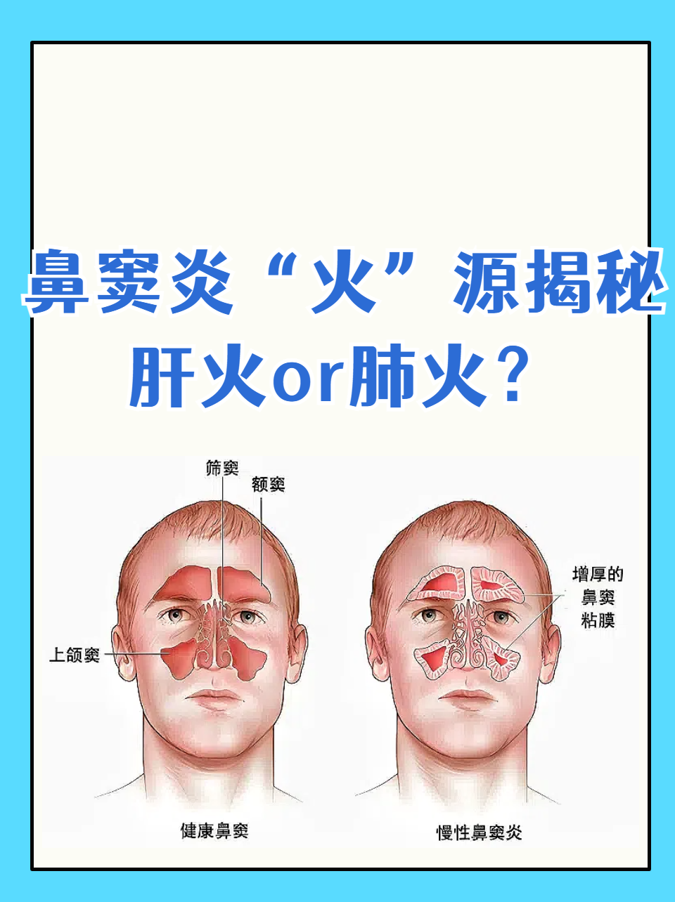 鼻窦炎"火"源揭秘:肝火or肺火?