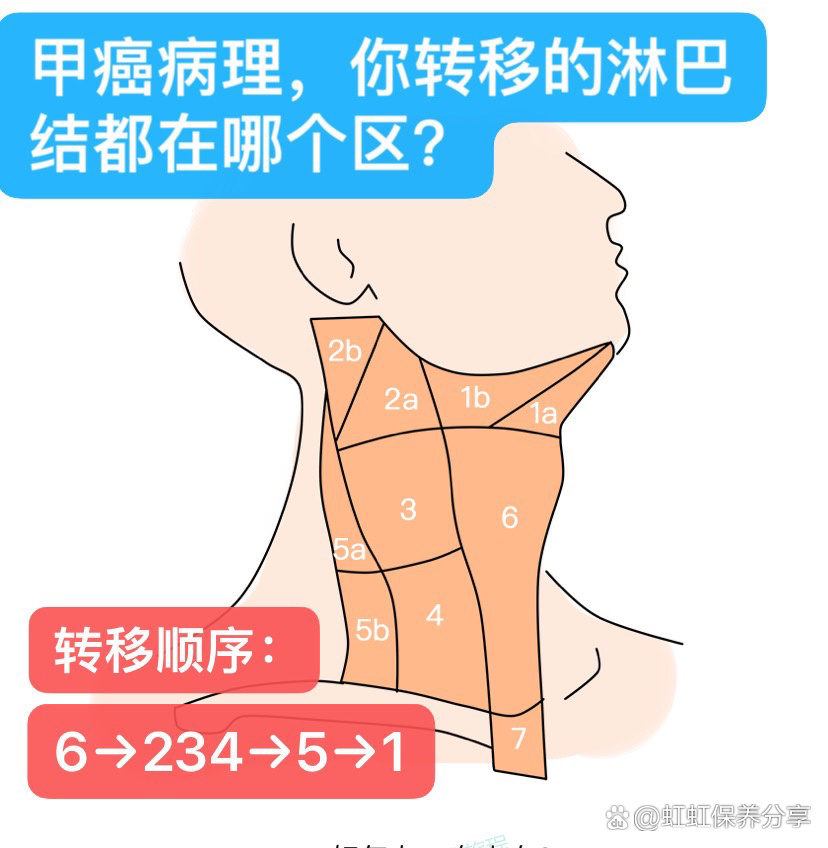 甲状腺分区图图片