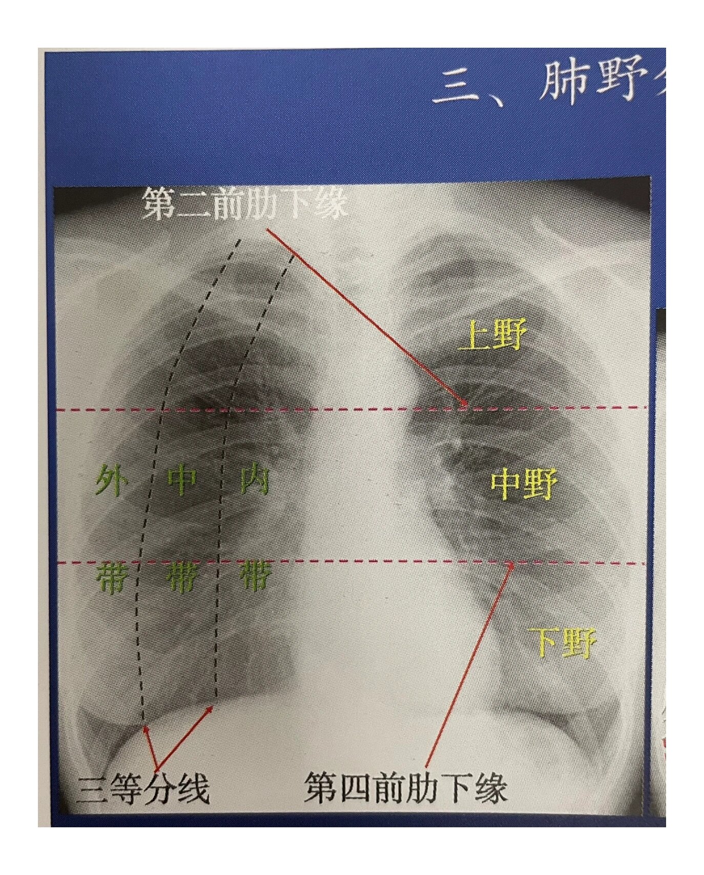 胸部正位DR详细解剖