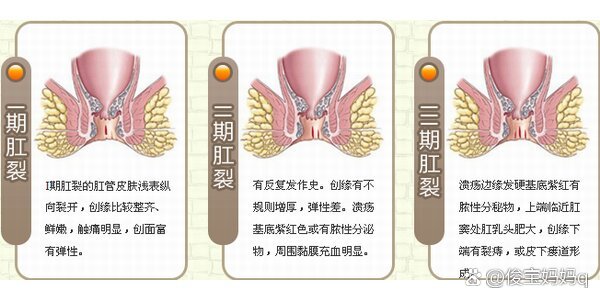 肛裂原因图片