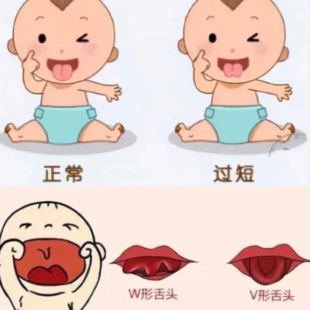 小孩舌系带短图片表现图片