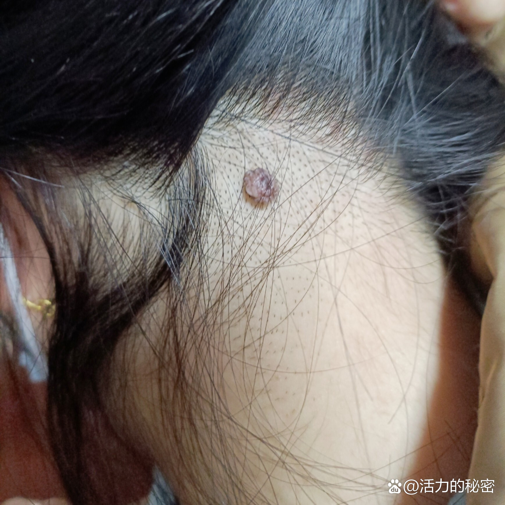 突出来的色素痣终于做手术去除啦