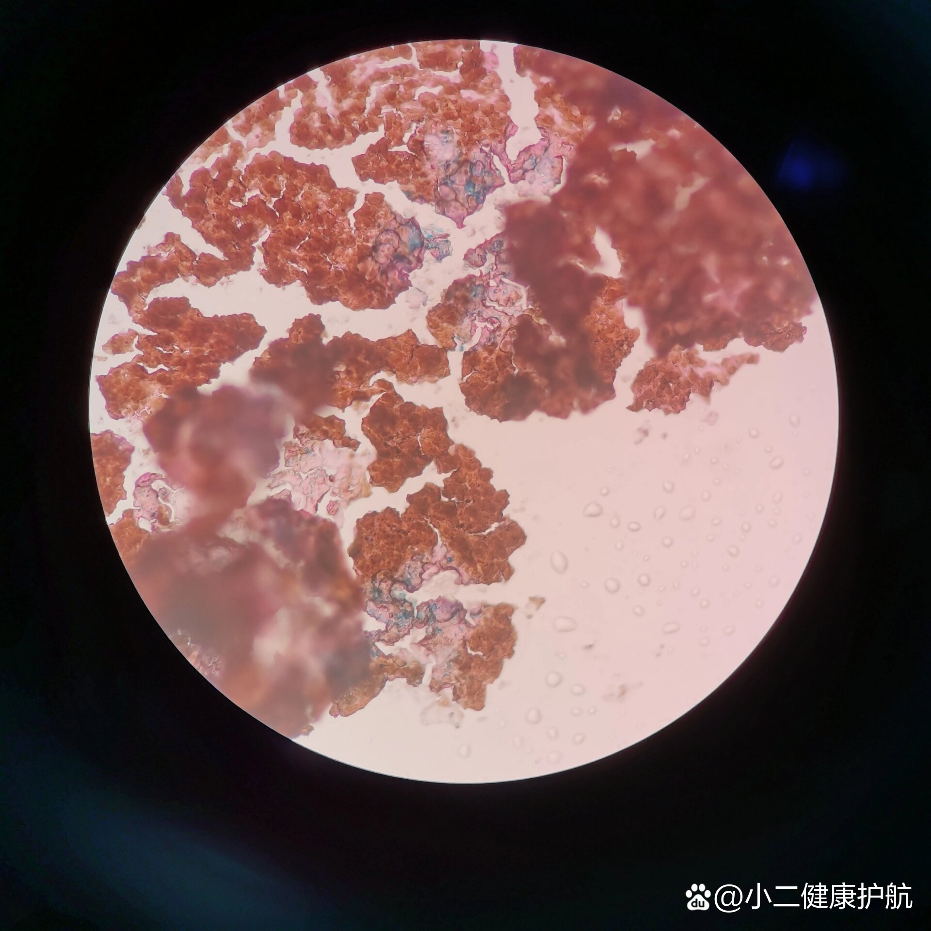 骨髓片铁染色 细胞外铁铁染色是临床应用最广泛的细胞化学染色