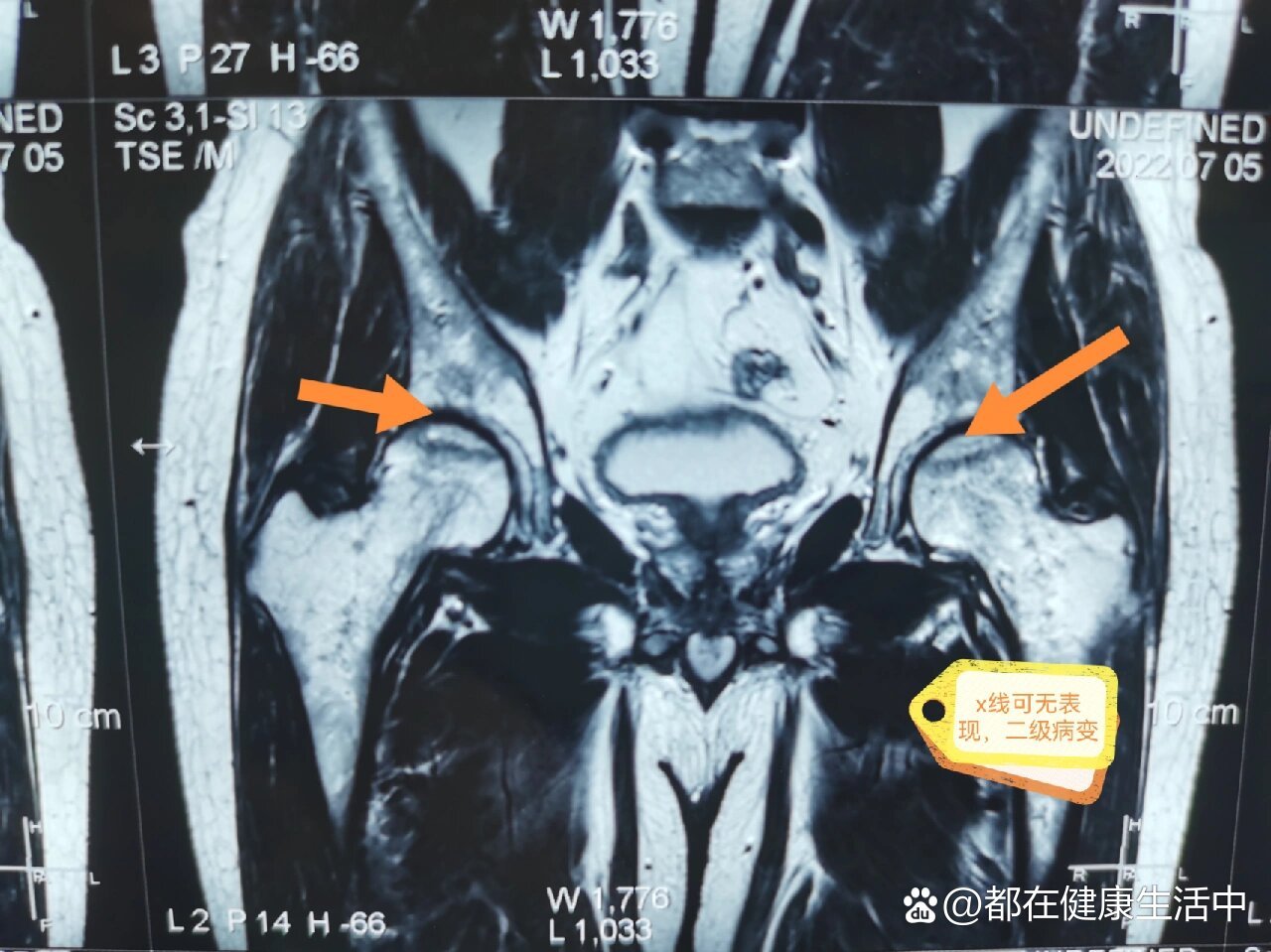 股骨头坏死磁共振图片