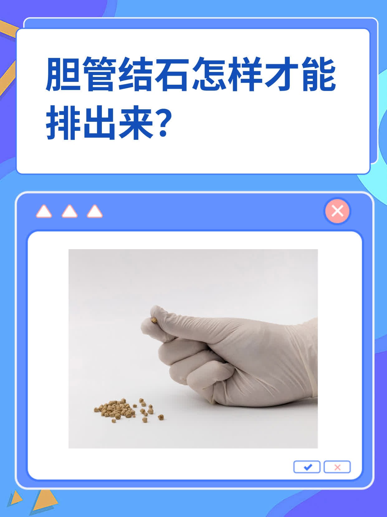胆管结石怎样才能排出来