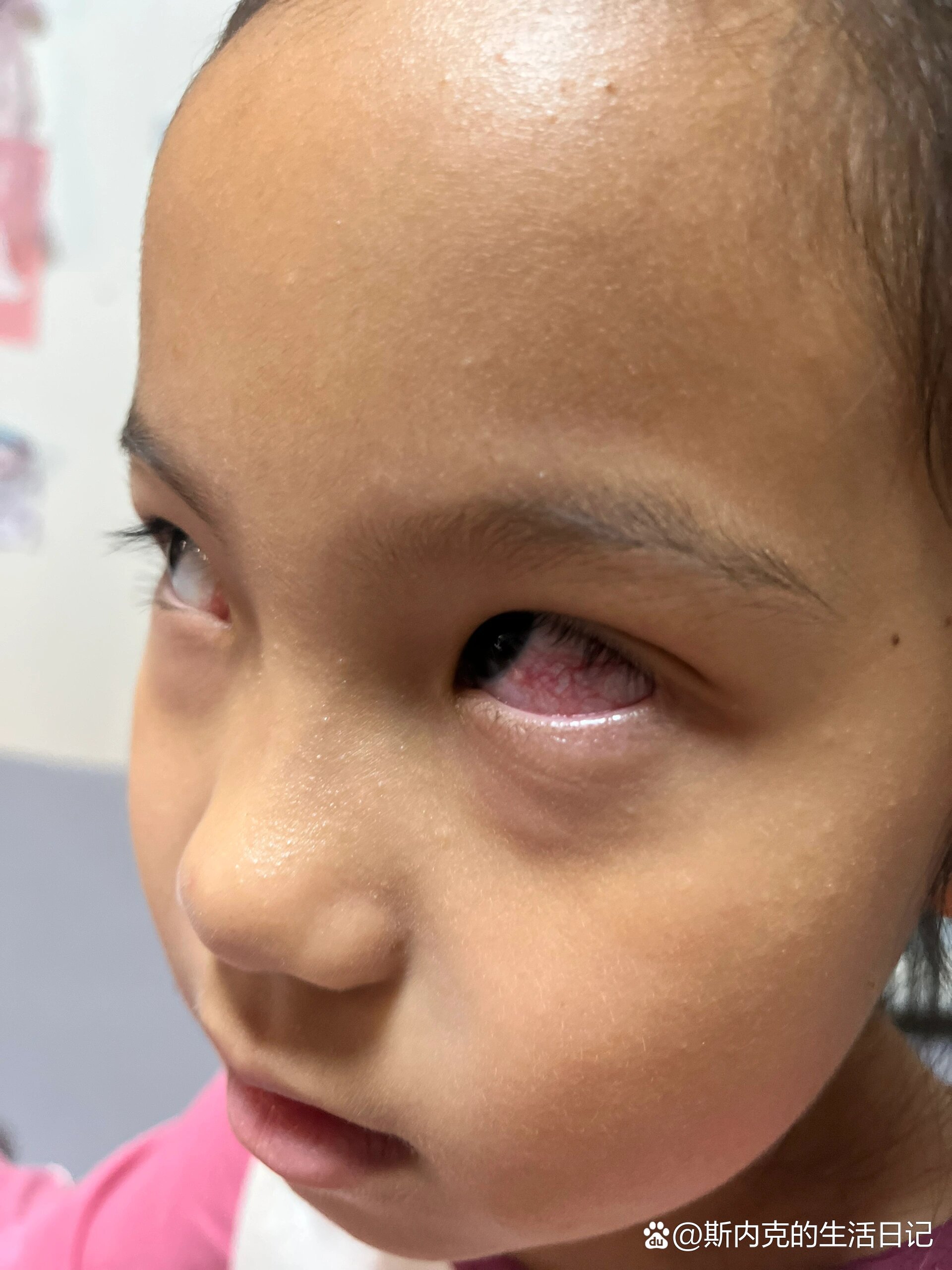 小孩子眼睛红血丝～结膜炎