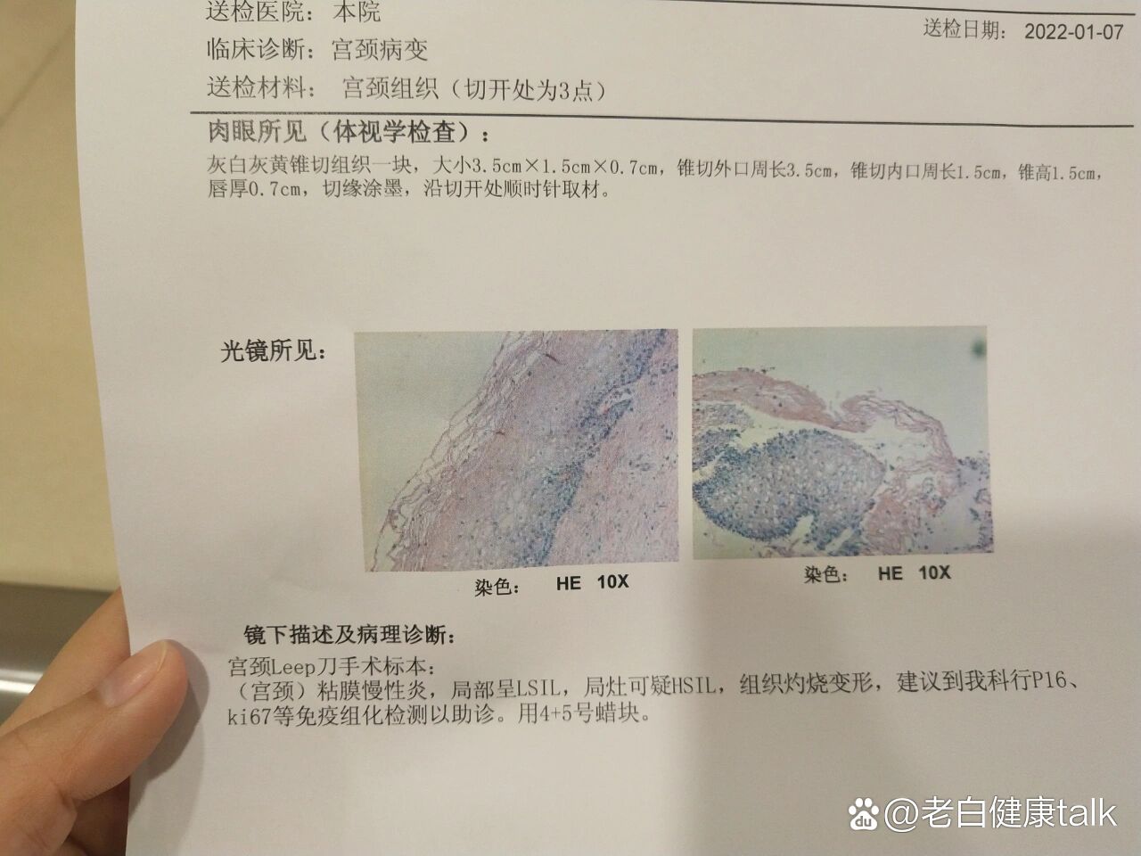 leep刀后的大病理结果,又要煎熬了～01