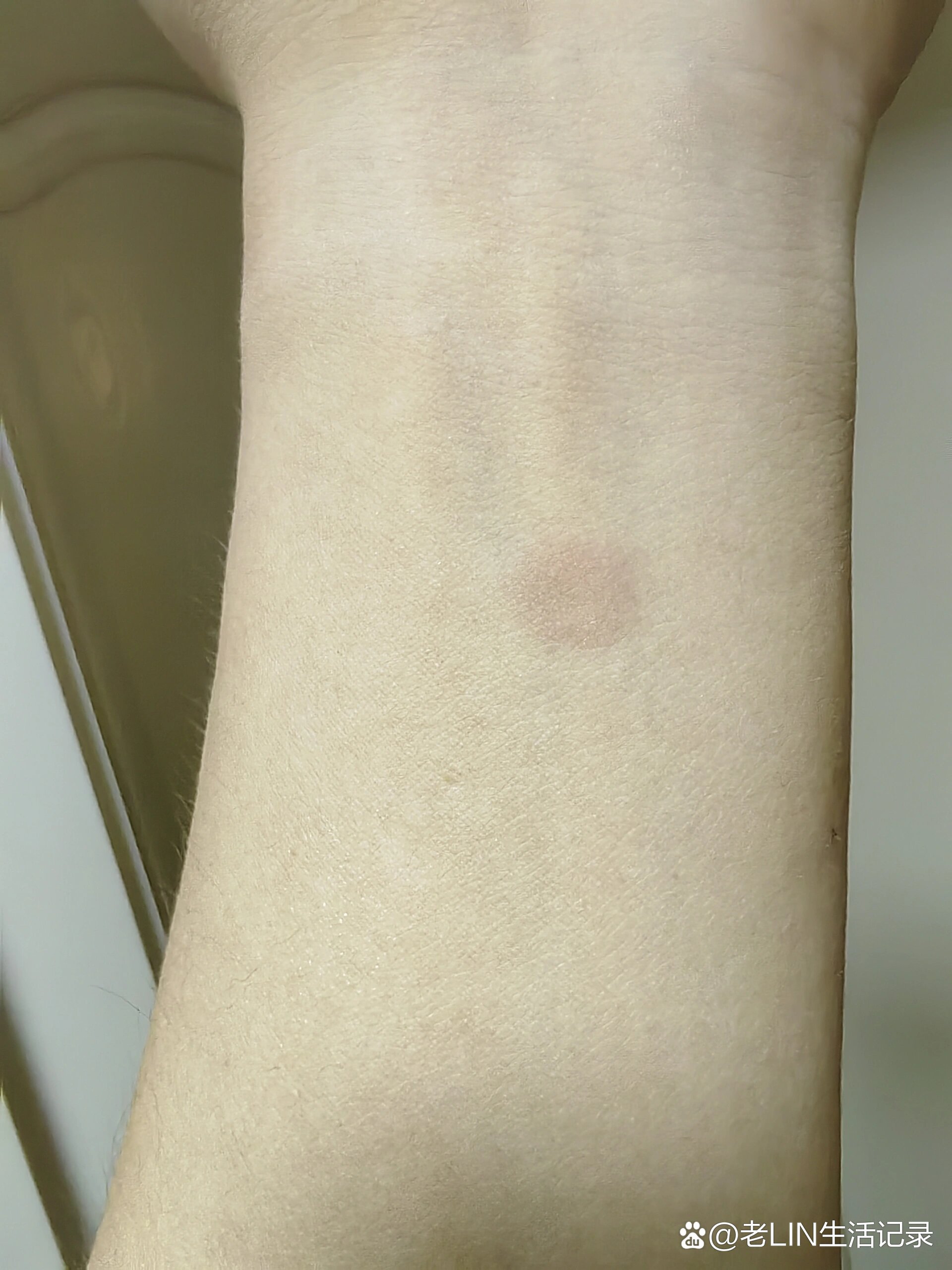 手臂起红块,大家知道是什么吗?