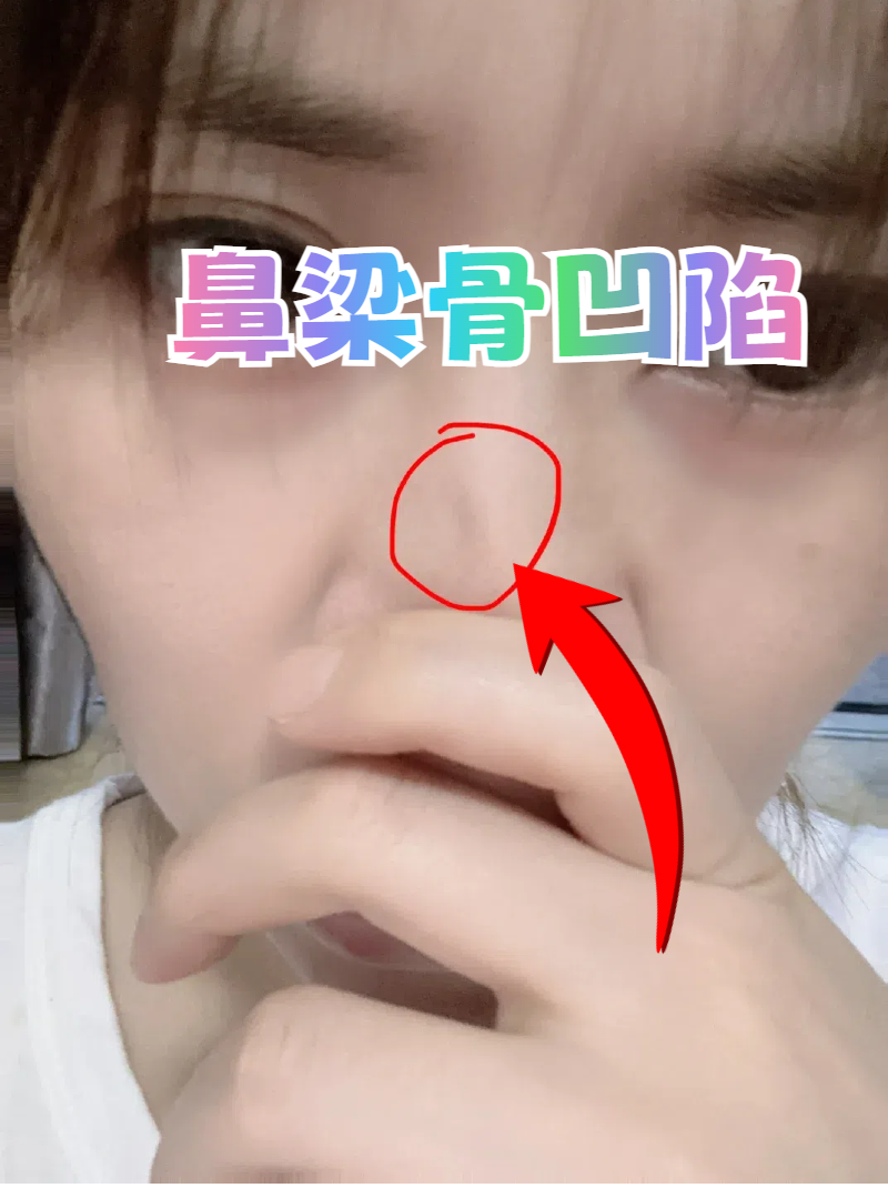 两眼中间鼻梁骨凹陷,可以试试这些方法!