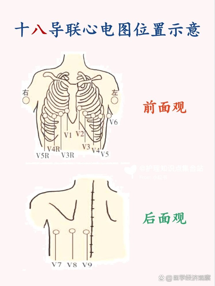 三导联示意图图片