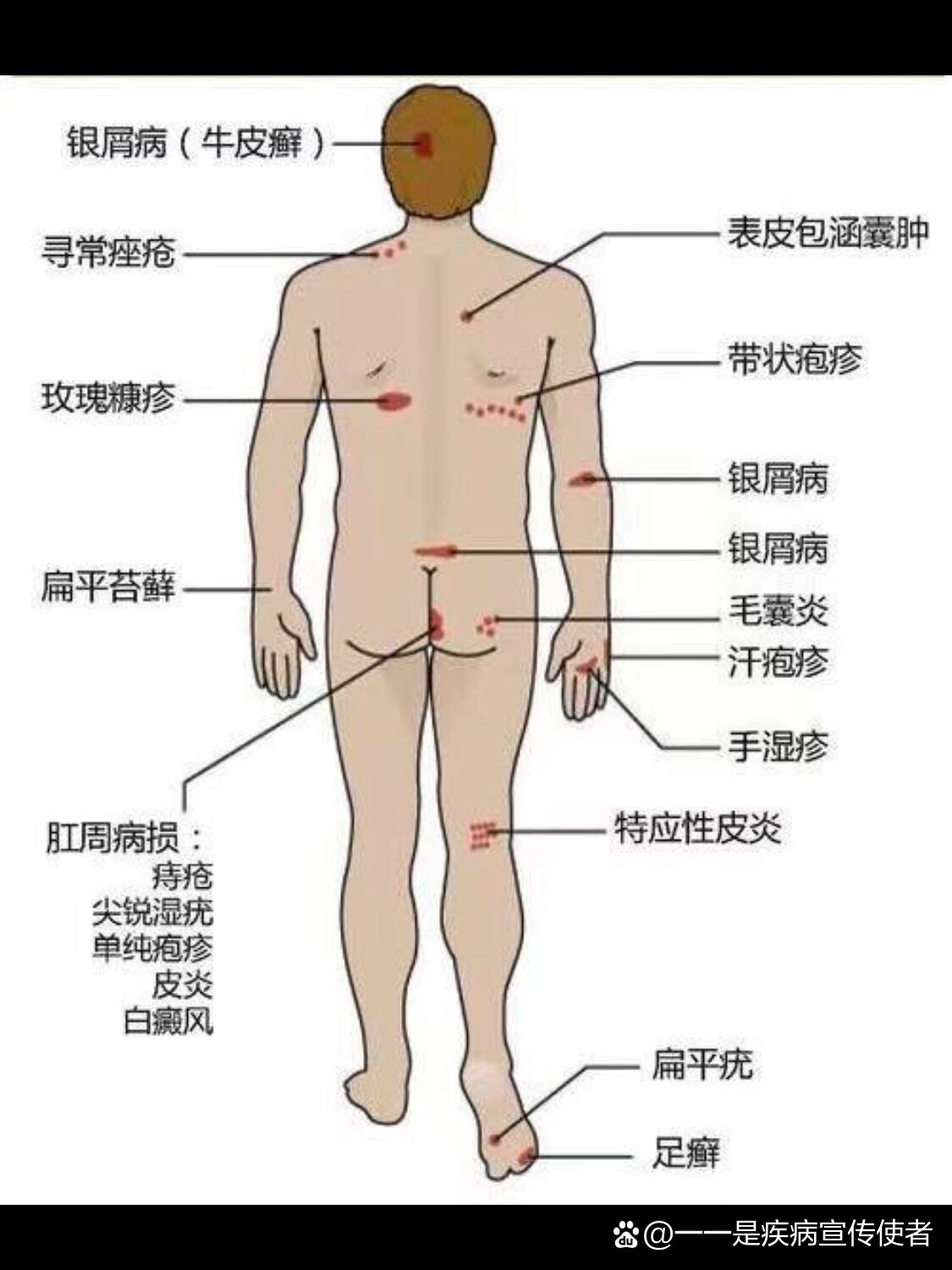 【皮肤病常见部位图