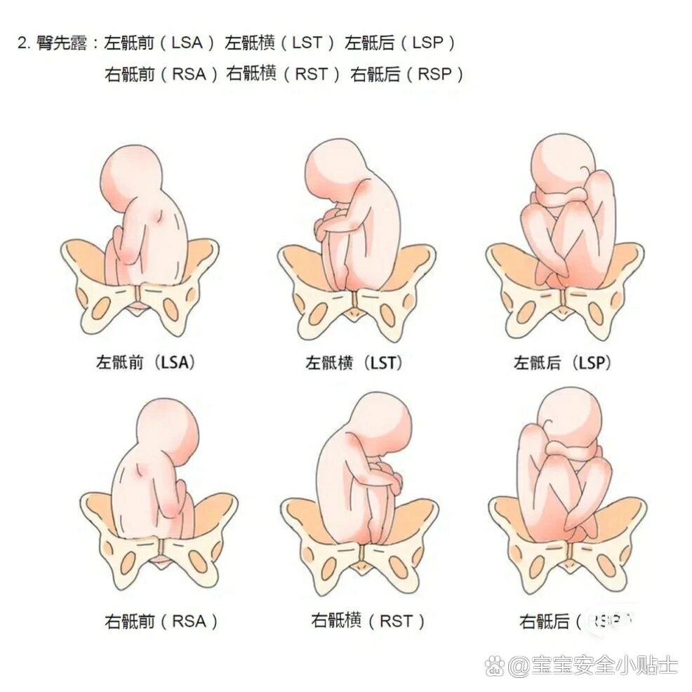 30周产检胎位lsa