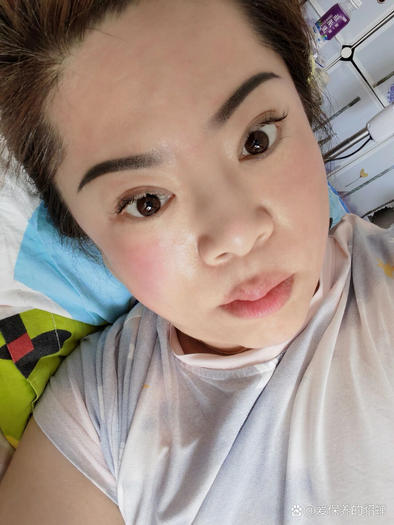 打完童颜水光针的第二天,从前晚开始,敷完富勒烯医用冷敷贴后,两侧的