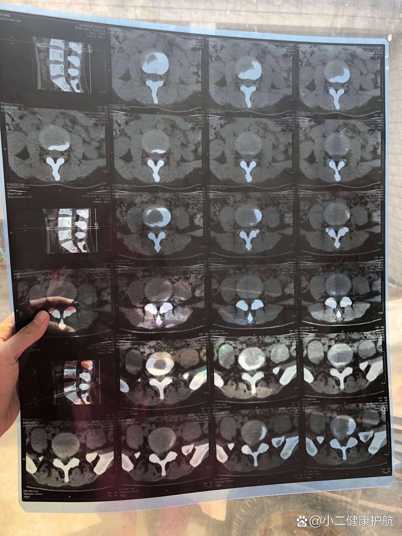 腰间盘突出伴椎管狭窄