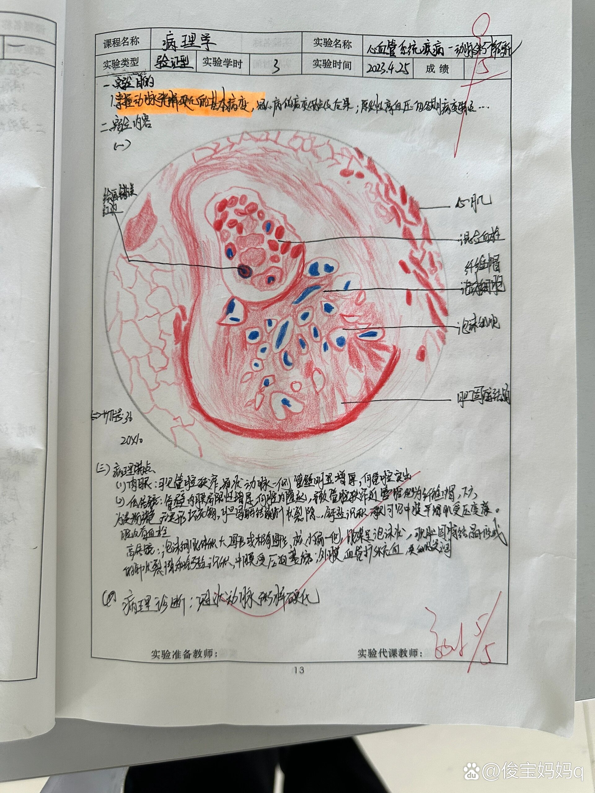 动脉粥样硬化红蓝铅笔图片