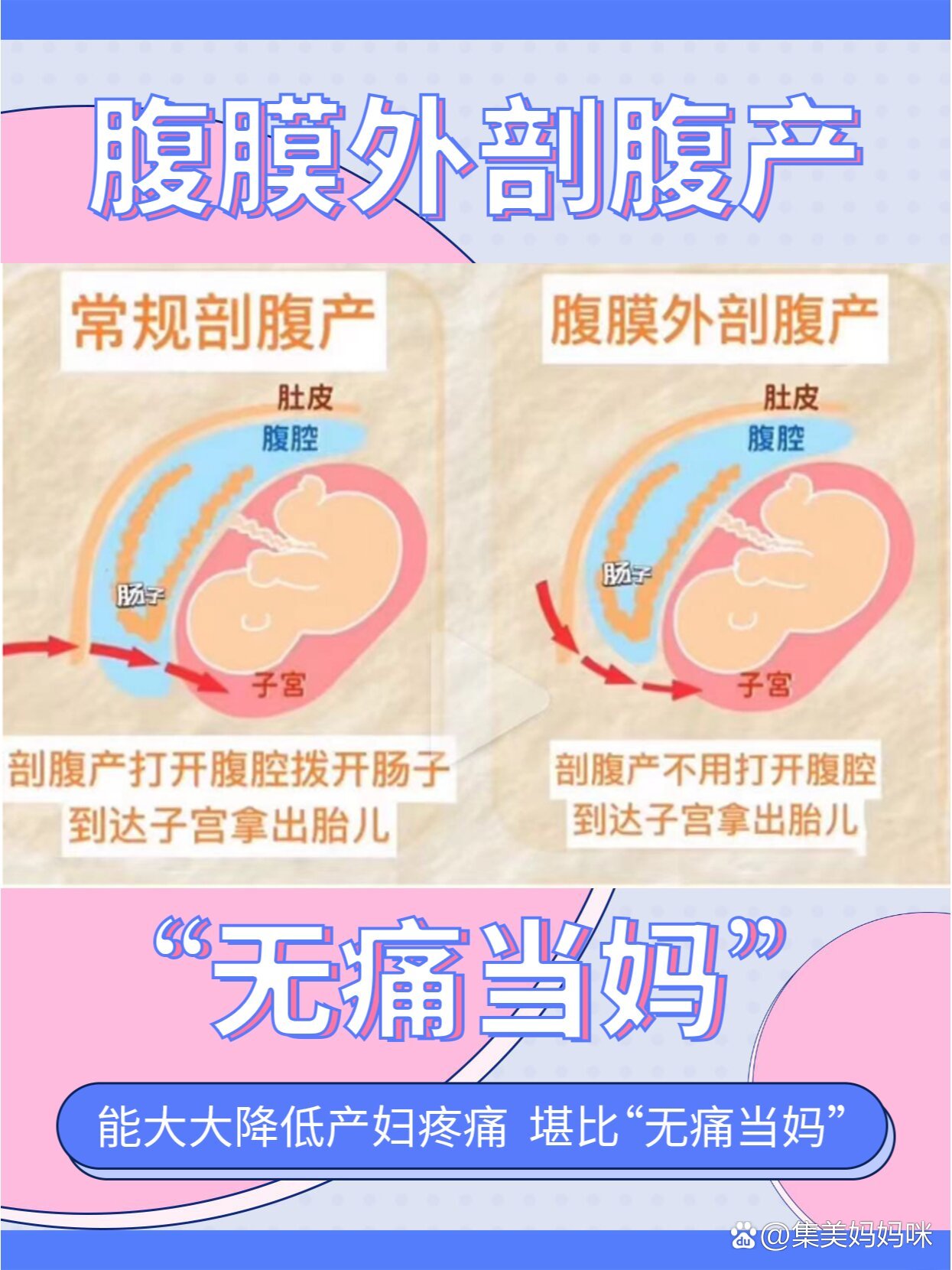 层一层划开皮肤脂肪筋膜腹肌腹膜等拨开肠子再剖开子宫娩出胎儿