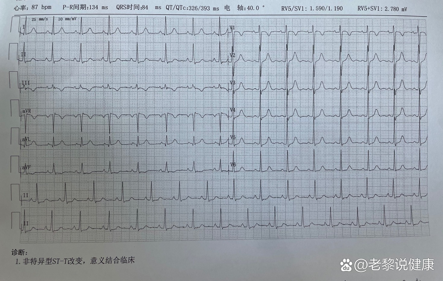 非特异型st-t改变是什么意思
