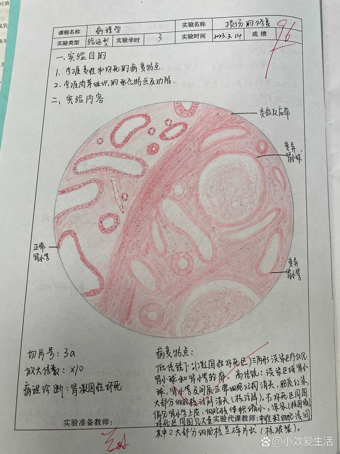 肾凝固性坏死手绘图图片