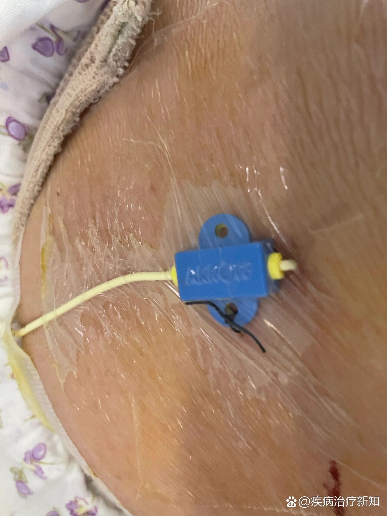 邵逸夫试管过程———取卵后腹水