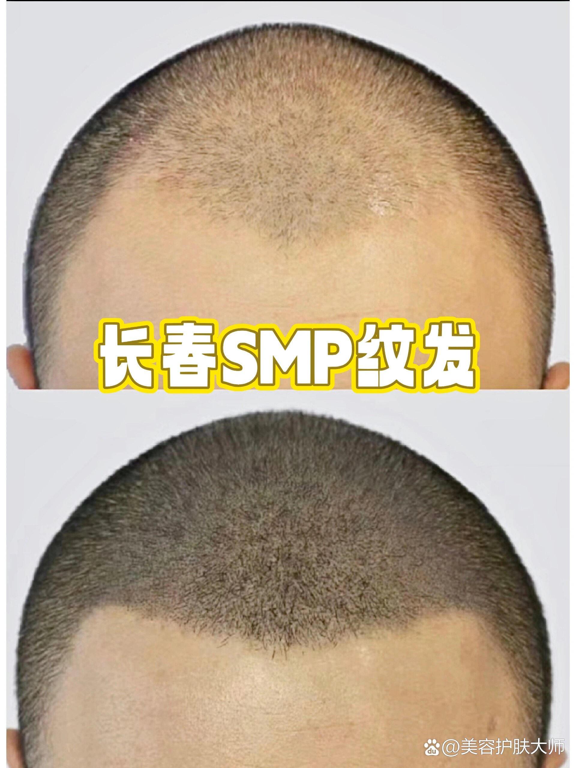 纹发和植发的区别