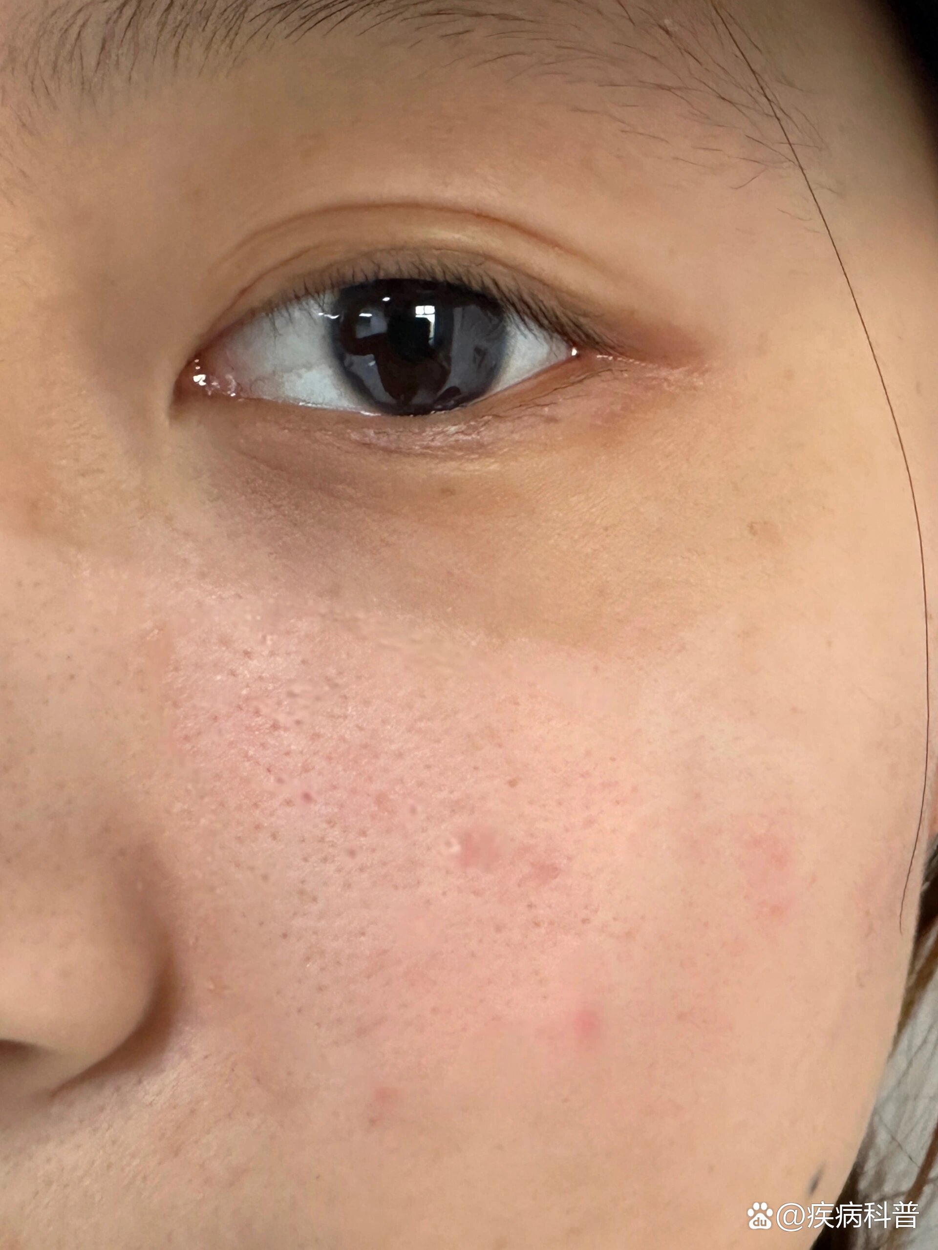 重度脂溢性皮炎成功上岸!