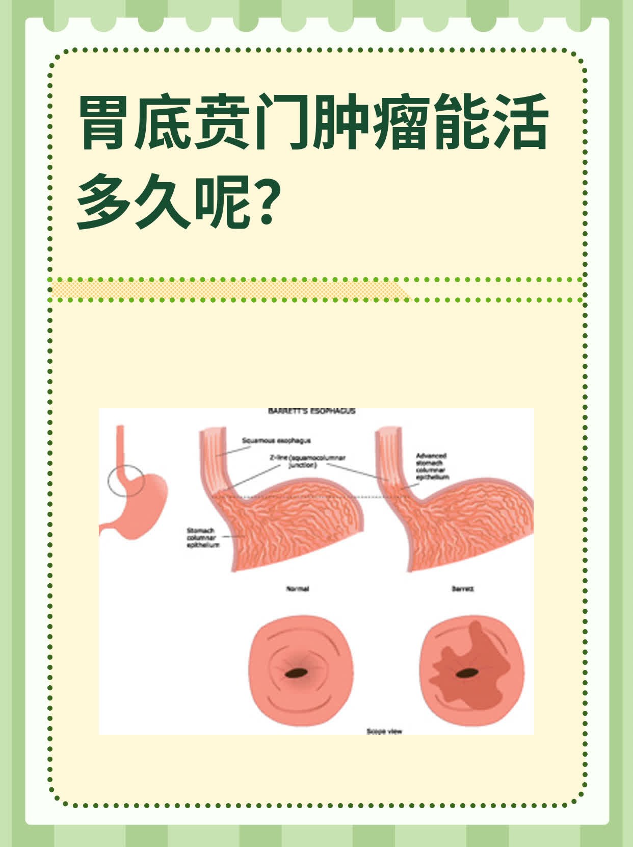 贲门癌治愈率图片