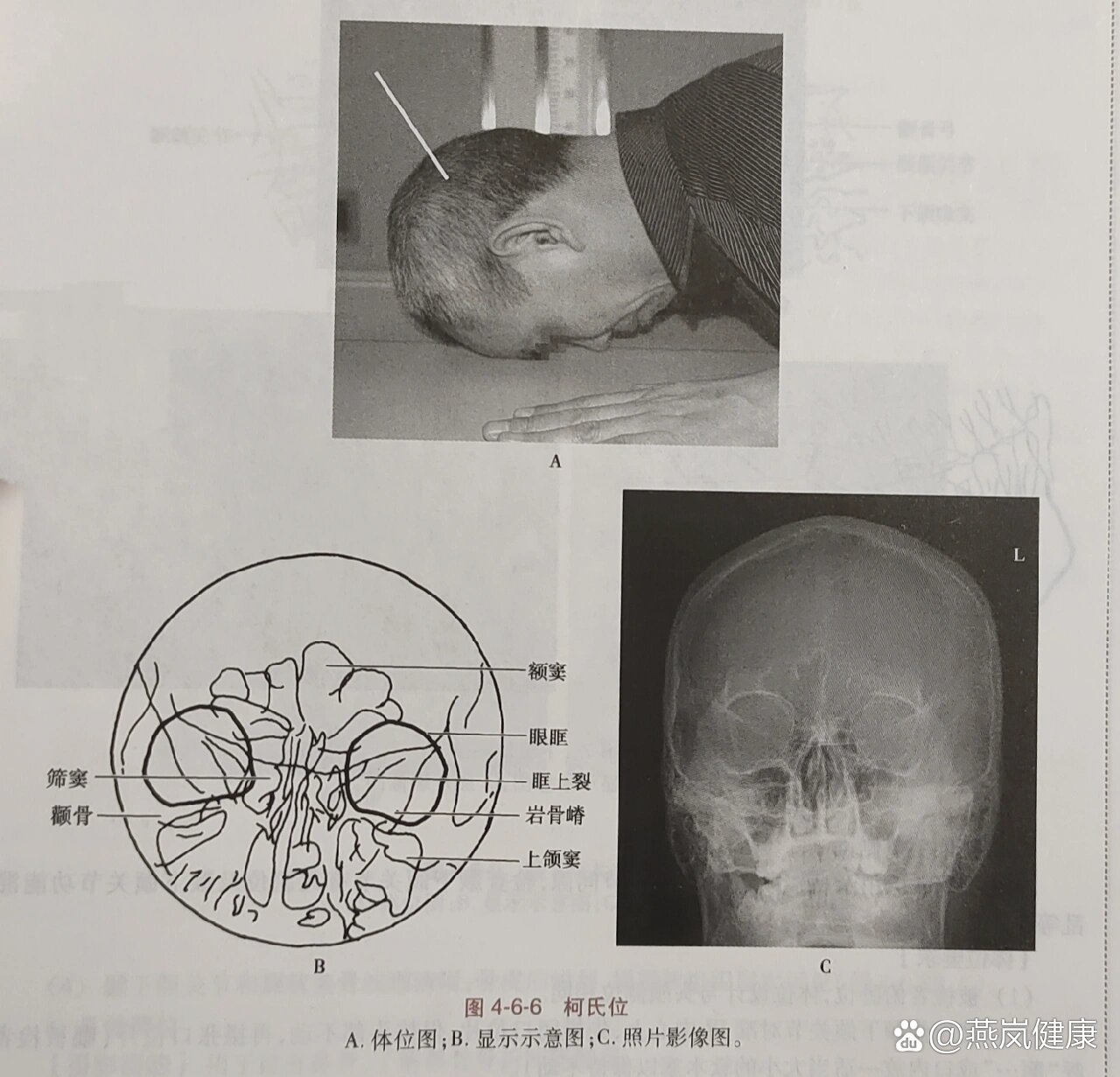 鼻旁窦柯氏位图片图片