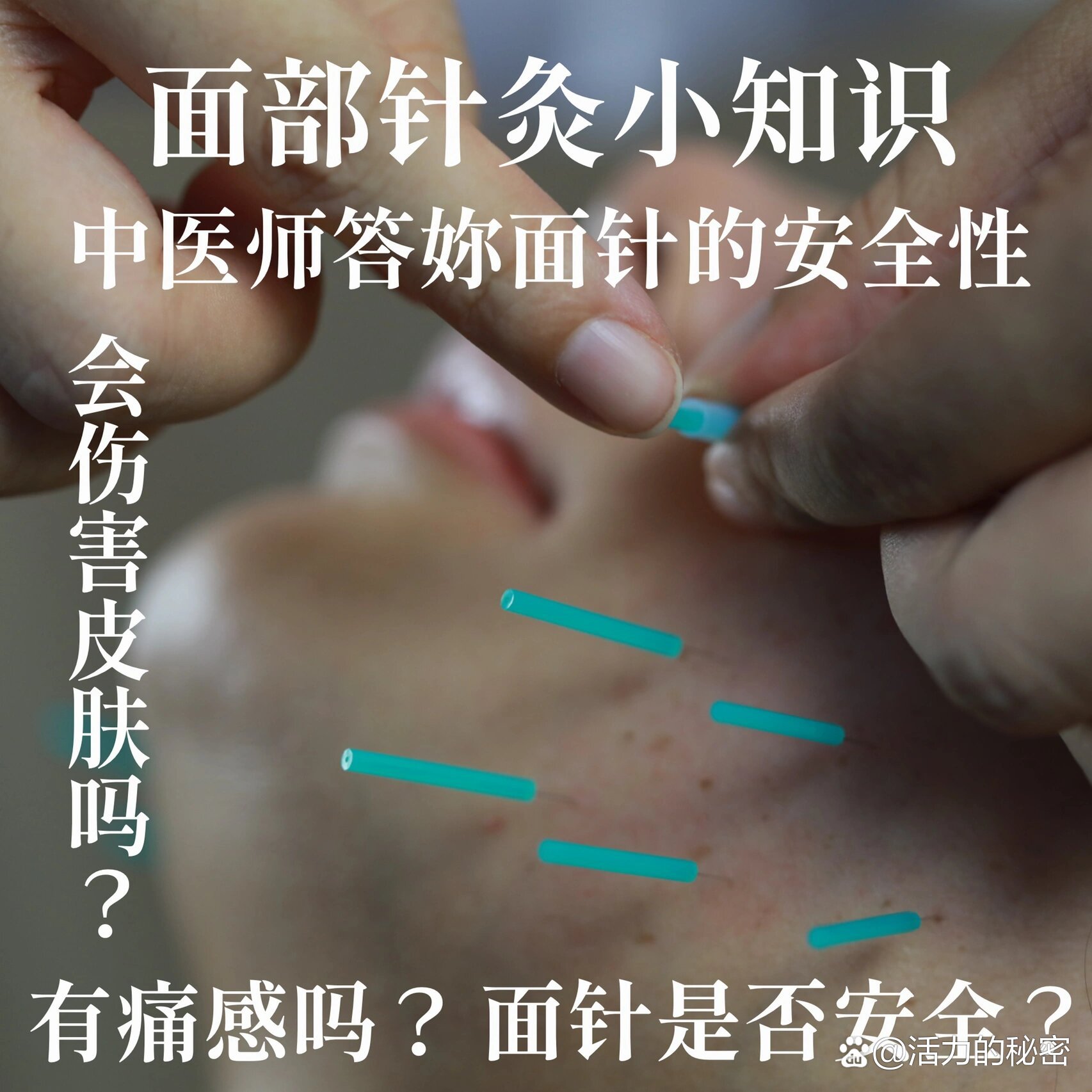 面部针灸小知识91中医师答妳面针的安全性