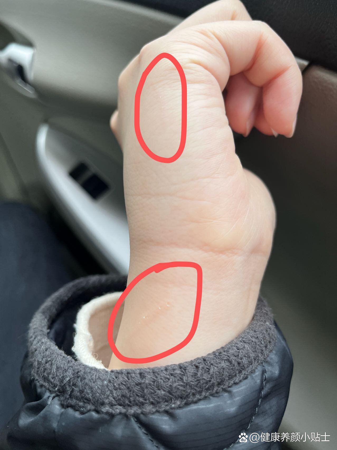 涂了碘伏伤口明显一些 br>猫咪体检报告狂犬病毒喂阴性 br>家人们