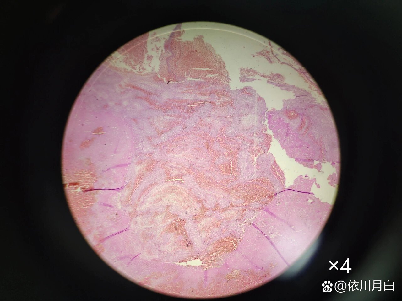病理组织观察——混合血栓