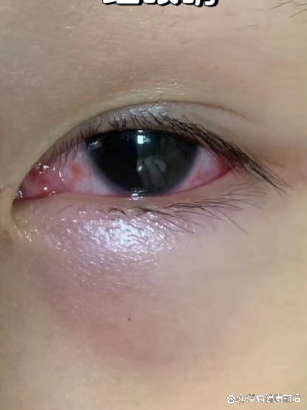 红眼病,眼球干涩胀痛,孕期气血不足导致眼花不论大人小孩,寻常