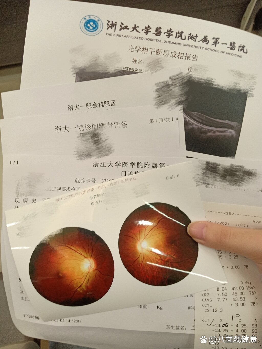 眼底检查|缓解1000多度的焦虑